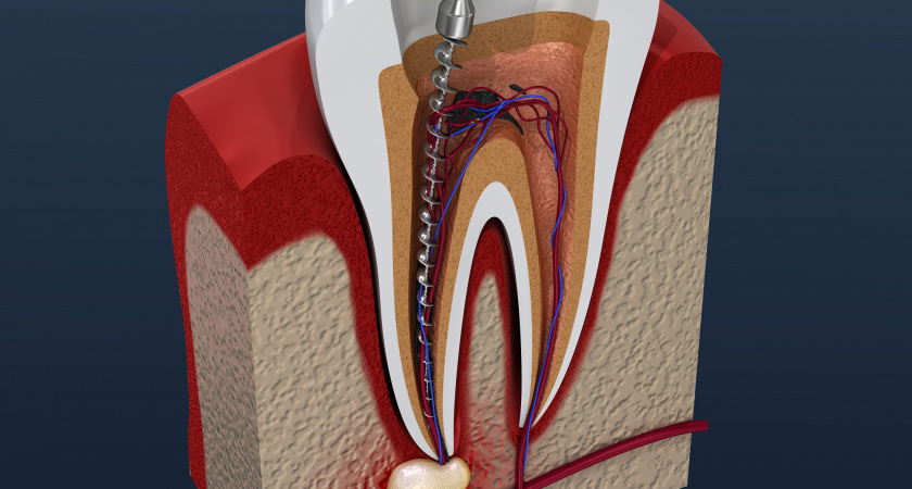 Во рту жителя Ухты оставили бор для сверления зуба