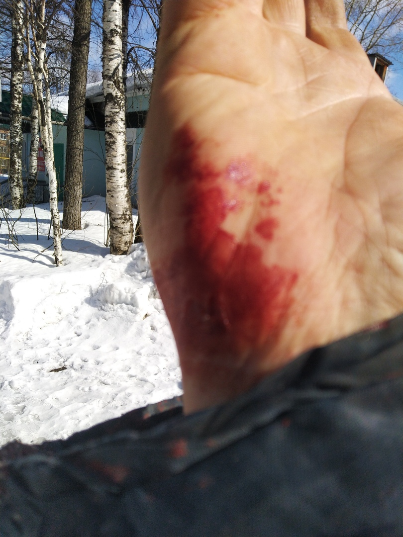 В Сосногорске мужчина разорвал руку из-за халатности коммунальщиков