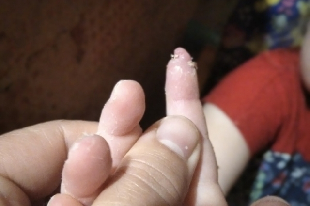 В Коми трехлетняя девочка лишилась части пальца в детском саду