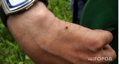 Какую опасность несут укусы клещей в Коми?