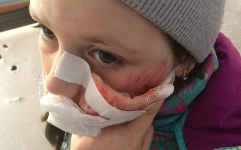 Под Сосногорском собака чуть не загрызла 9-летнюю девочку, ребенок направлен в больницу