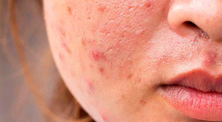 Как избавиться от прыщей март 2021 Новости Ухты Про