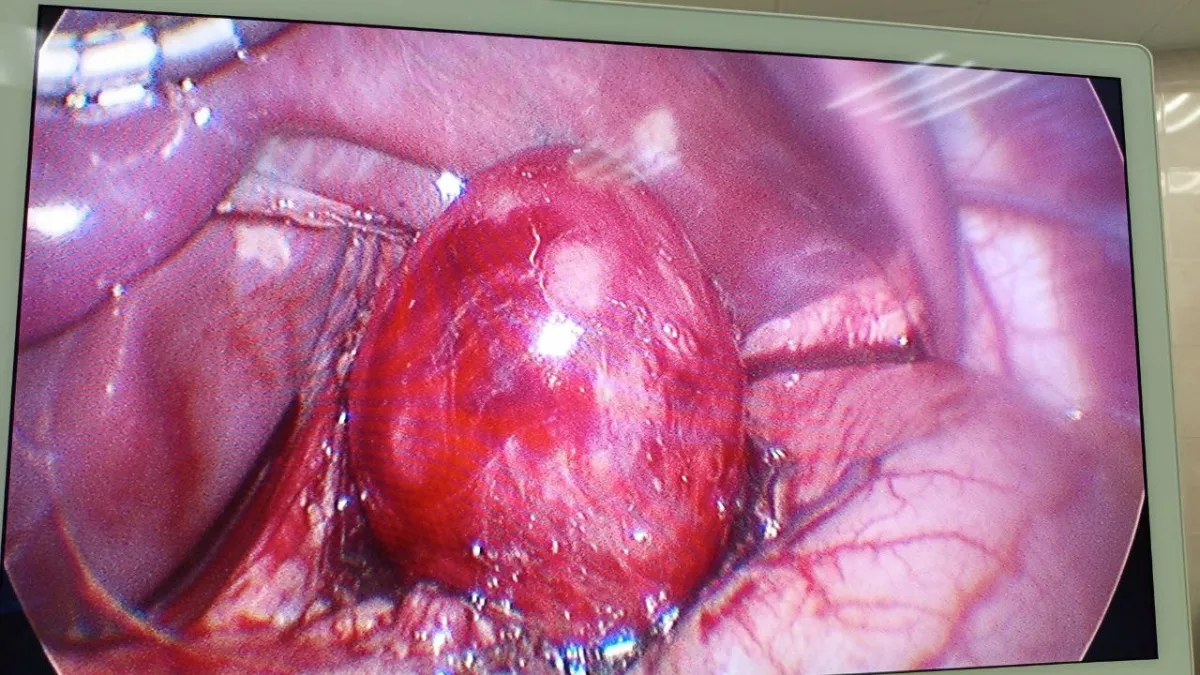 В Коми врачи удалили редкую кисту желудка семилетнему ребенку